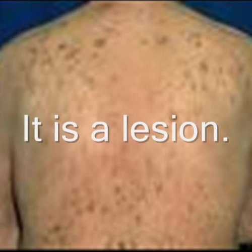 1a. Seborrheic Keratosis