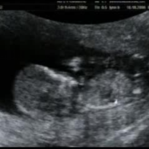Ultrasound Scan 12 weeks