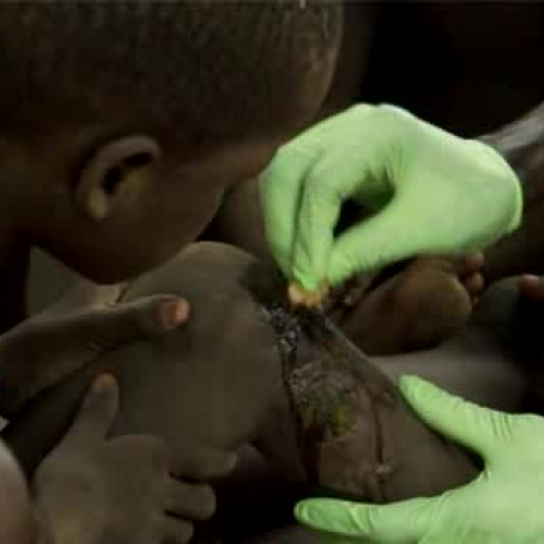 SUDAN Carter Center Eradicate Guinea Worm Dis