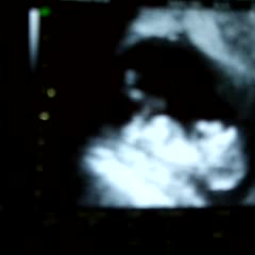 ultrasound