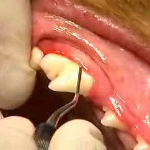 Subgingival Scaling of Canine Tooth