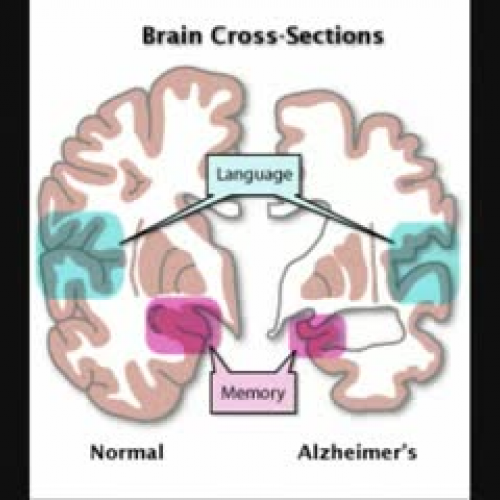 Alzheimer's Disease
