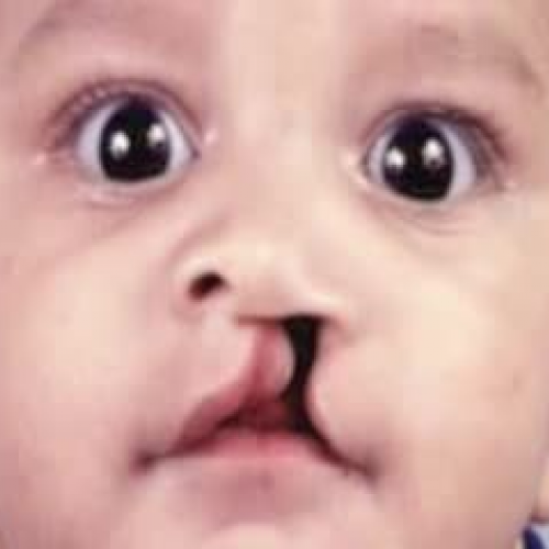 cleft lip / palate