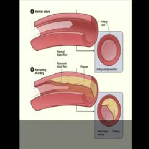 Atherosclerosis