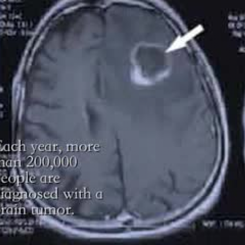 Brain Cancer
