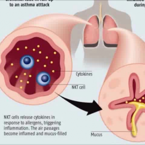 Raising Awareness About Asthma