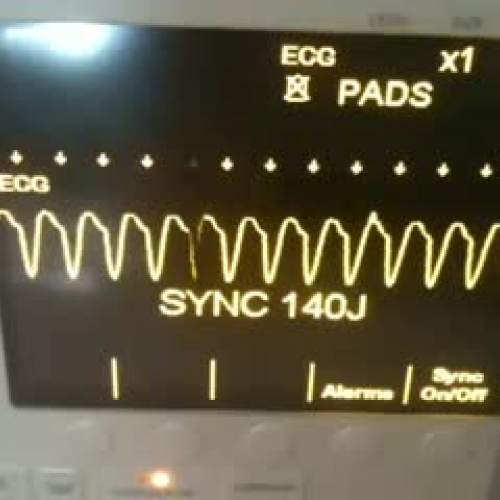 Ventricular Tachycardia