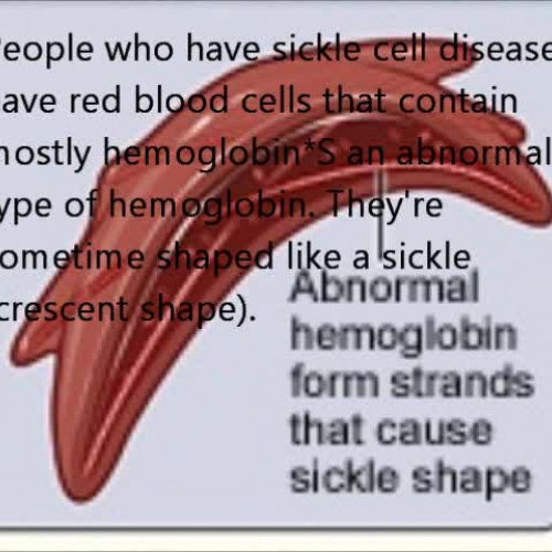 Sickle Cell Anemia