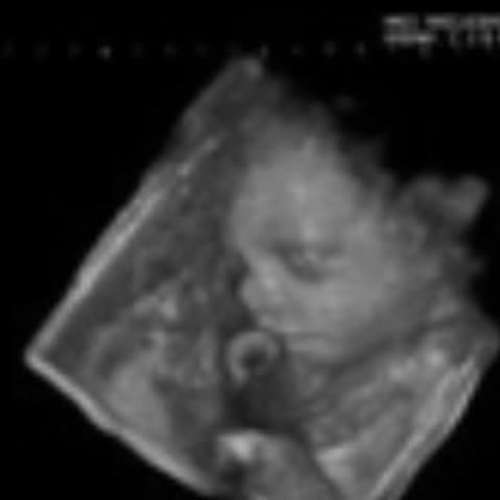 Abortion photos (Video)