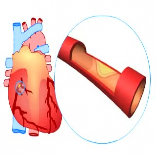 What causes a heart attack_