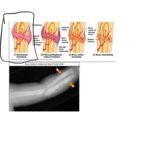 Repair of bone