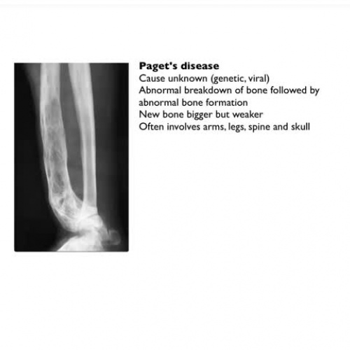 Pagets disease