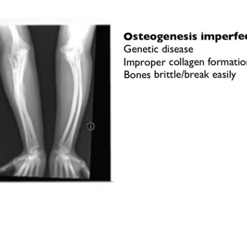 Osteogenesis imperfecta