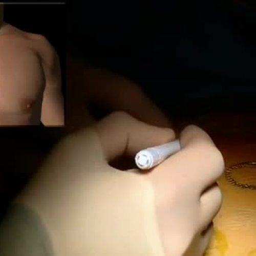 Mini AVR is best method for valve replacement aortic valve replacement 