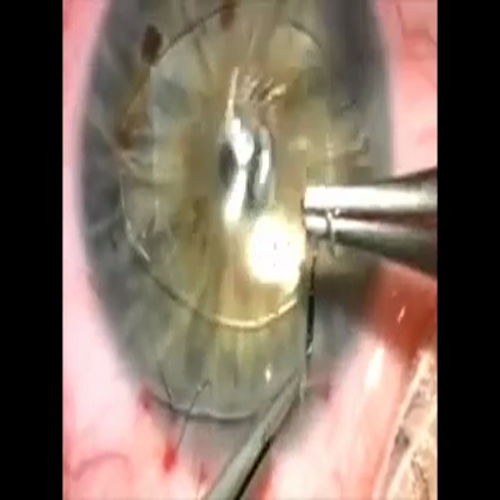 eye lens  replacement - intraocular lens surgery