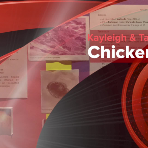 Chicken Pox Presentation