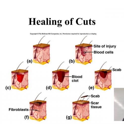 Cuts and burns