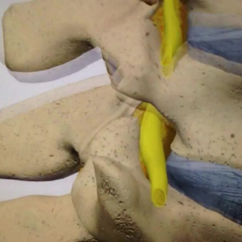 Lumbar Degenerative Spondylolisthesis 