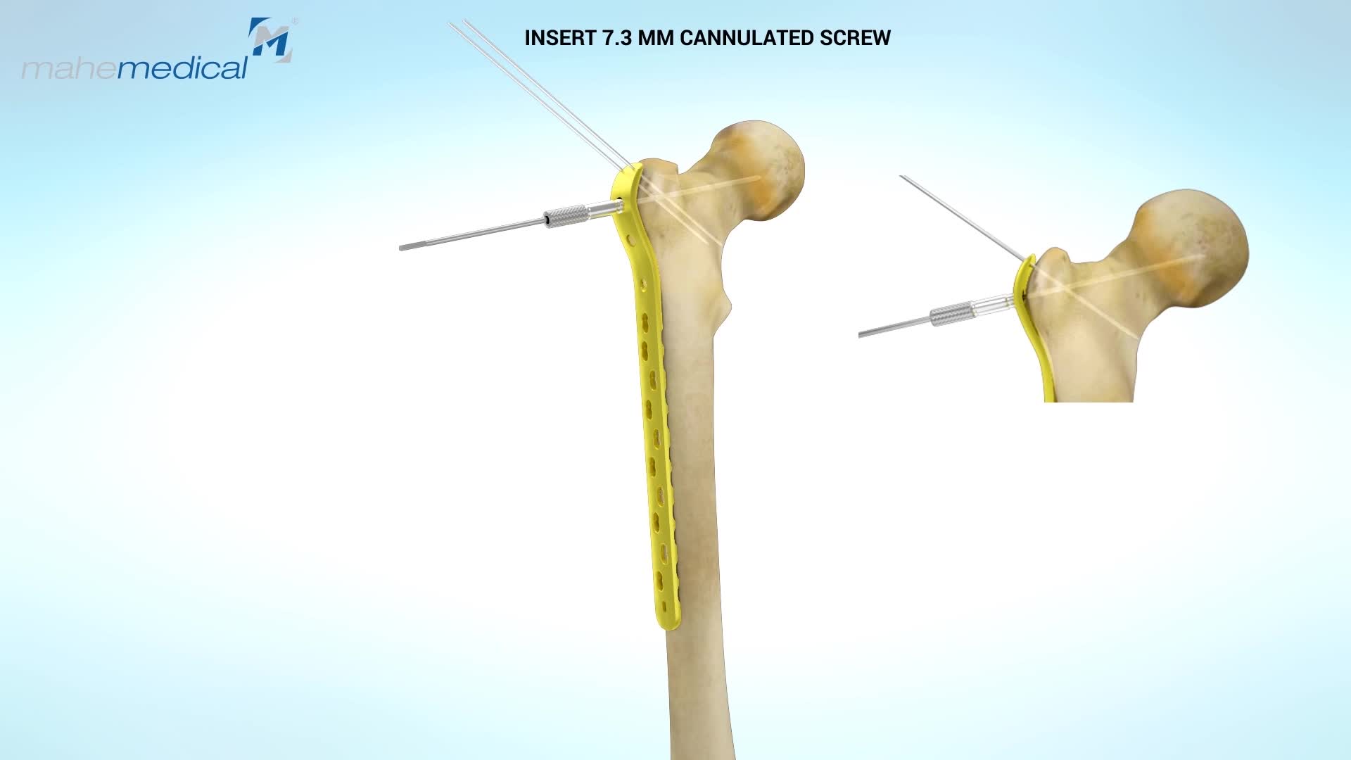 Medical Bone Animation